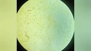Strongyloides stercoralis larva in stool