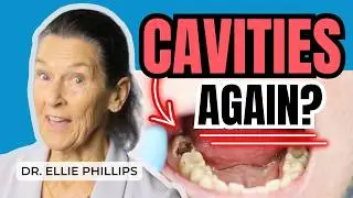Why Do You Get Cavities?