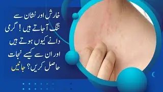 گرمی دانے کیوں ہوتے ہیں آور ان سے کیسے نجات حاصل کریں ؟ جانیی