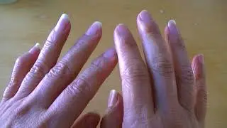 Battling winter dry hands, skin peeling, and cracked fingertips