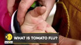 Tomato flu: Suspected virus affecting kids in India under age of 5 | WION