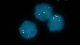 Genetic basis of a leukemia subtype revealed along with a possible targeted therapy