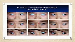 Isolated muscle palsy of third Nerve- Medial rectus, superior rectus, Inferior Rectus, IO palsy.