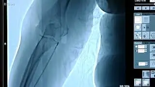 Balloon-Assisted Tracking to Overcome Radial Spasm during Transradial PCI.