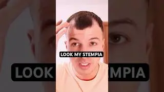 TRAPIANTO DI CAPELLI - LA MIA TRASFORMAZIONE