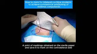 Marking for bilateral cochlear implants to achieve symmetrical positioning of external components
