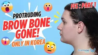Facial Feminization Surgery in Korea: Dream Come True or Regret? P1. | Male to Female Transformation