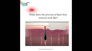 What happen when you do hair laser removal #laser #hairlaser #hairlaserremoval