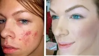 Full coverage acne foundation using Bare Minerals