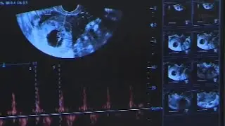 Proposed 15-week abortion ban in Virginia