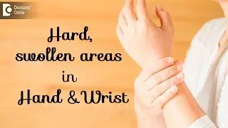 Bone Spurs in the Hand & Wrist | Hard, swollen areas in Hand & Wrist - Dr. Mohan M R|Doctors' Circle