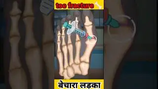 toe fracture #asmr #asmrcommunity #shorts