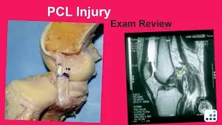 PCL Injury Exam Review - Raymond Kim, MD