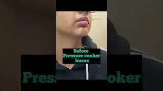 Pressure cooker burns | Before & After | #ladydermatologist  #parisaskinclinic #expertdermatologist