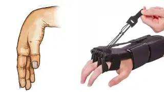 wrist Drop/radial nerve palsy #wristdrop #radialnerve #exercise #physiotherapy #splint