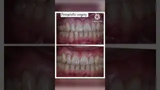 gingival recession #dentallife #dentist #doctor #dentallove #smile #smiledentist