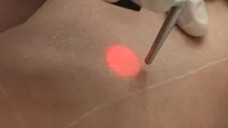Epilation Laser Paris - Précautions après une séance.