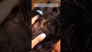 മുടിയിലെ താരൻ മാറാൻ