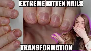 EXTREME BITTEN NAIL TRANSFORMATION | on myself doing a natural baby boomer look