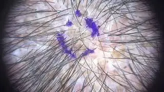Inflammation and Fibrosis in Androgenetic Alopecia &ndash; Video S1 [548520]