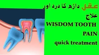wisdom teeth problems