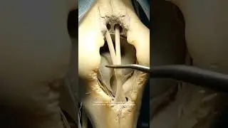 ACL injury l ACL tear l Knee injury l injury prevention l sports injury l physiotherapy#viral#reels