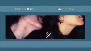 Skin Laser & Surgery Specialists - Port Wine Stain Birthmark Removal - New York & New Jersey