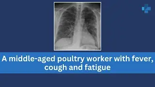 A middle-aged poultry worker with fever, cough and fatigue