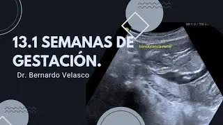 13.1 SEMANAS HEMATOMA RETROCORIAL DE 4.7 CM TRANSLUCENCIA NUCAL 0.25 mm