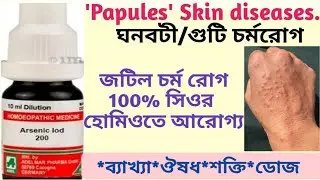 (799) ঘনবটী/গুটি চর্ম রোগের হোমিও চিকিৎসা -Papules homoeopathy treatment.