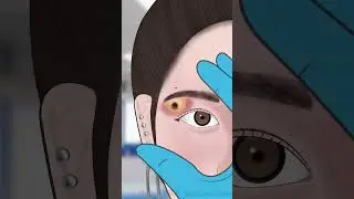 ASMR Satisfying eyebrow piercing pus removal animation #shorts #asmr