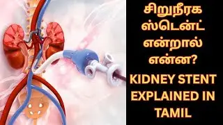 சிறுநீரக ஸ்டென்ட் என்றால் என்ன? | Kidney Stent (Side Effects & Recovery Tips) Explained in Tamil
