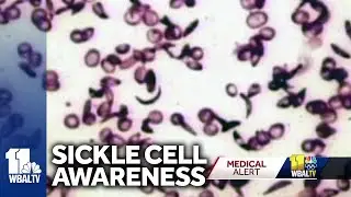 Sickle cell disease: Why patients need blood from African Americans
