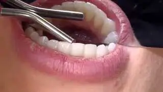 How to use a dental air-water syringe