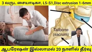 L4L5 disc herniation | L5-S1 disc extrusion 1.6 mm # Sciatica, recovery without surgery