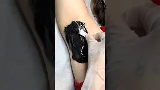Underarm wax ingrown hair  removal blackhead removal on underarms #hairremoval #ingrownhair #waxing