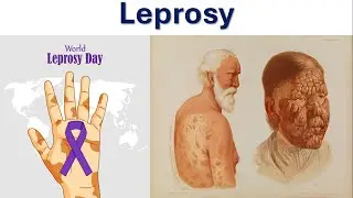 Understanding Leprosy, Its Causes, Symptoms, Treatment & Prevention || Hansen's Disease || M. Leprae