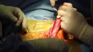 Salvage Subcoronal Penile Implant Surgery in Scarred Penis by Dr Hakky Resurrection Atlanta