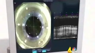 Toyos Clinic on WSMV - LASIK for Cataract