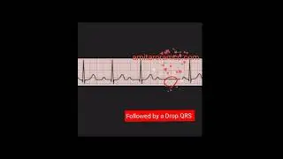 AV Blocks I Mobitz type-1 ,Second degree Heart Block