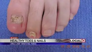 Lunula Laser targets nail fungus