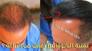 عملية زراعة شعر بدون منطقة مانحة؟