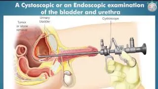 Don&rsquo;t Ignore Blood in Urine (Hematuria) | India Medical Hub