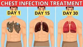 7 Natural Remedies to Treat Chest Infections at Home