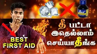 First aid for burn | How to treat burn : Basic first aid tips |