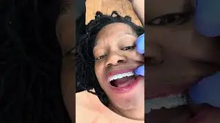 January 2024 - month 6 #metalbraces 4th |adjustment powerchains and rubber bands #bracesvlog #braces