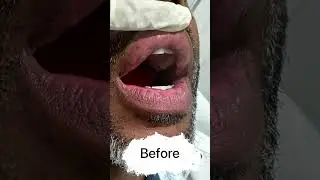 ✨ Lip Pigmentation Correction with Pico Laser ✨