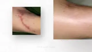 Scar Treatments at Beautiful You By Christine