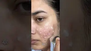 REEDLE SHOT 300  ✅✨#koreanskincare #reedleshot #microneedling #skincare #vtcosmetics|