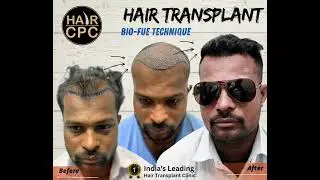 BIO- FUE HAIR Transplant @hairskincpc